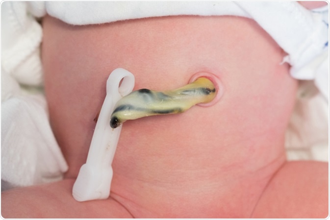 Umbilical cord cut and clamped right after birth of the newborn baby but still attached to the navel. Image Credit: Semmick Photo / Shutterstock